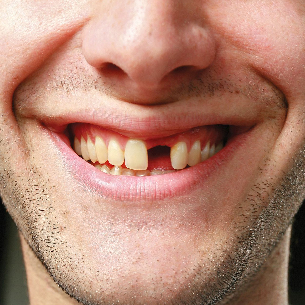 Открытый рот мужчины. Челюсть без переднего зуба.